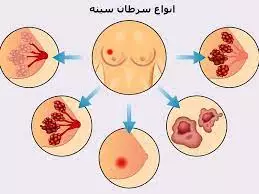 مرحله 4 سرطان پستان