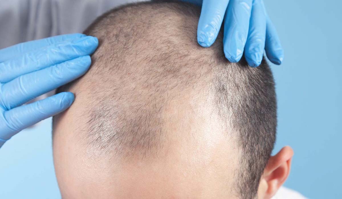 مراقبت های پس از کاشت مو