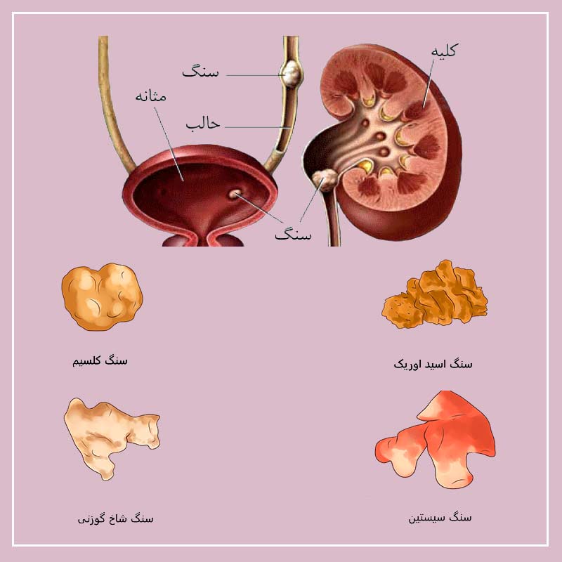 سنگ کلیه