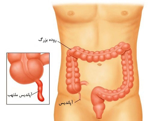 آپاندیس