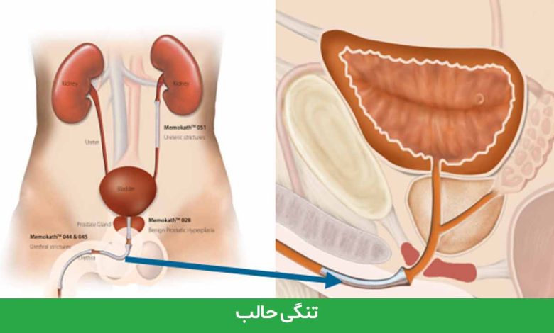 تنگی حالب