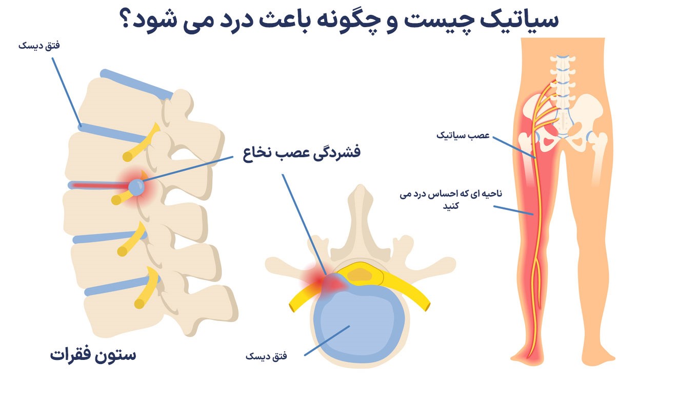 سیاتیک