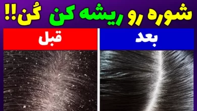 شوره سر