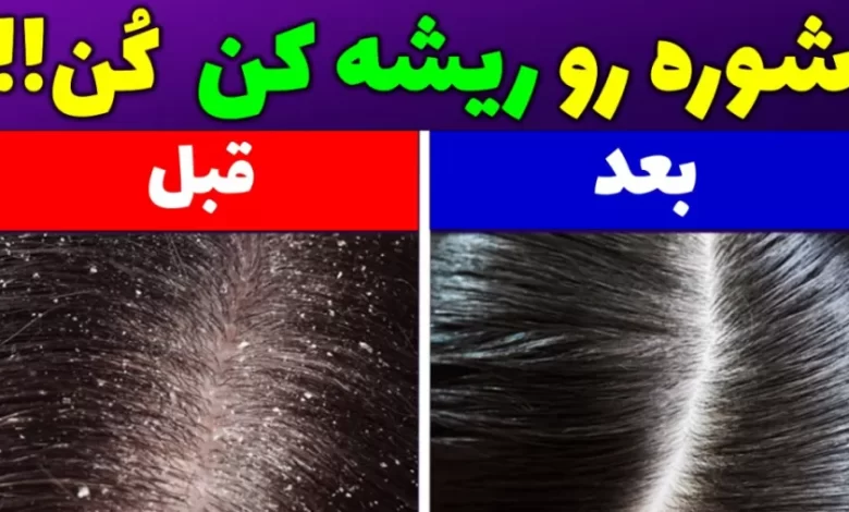 شوره سر
