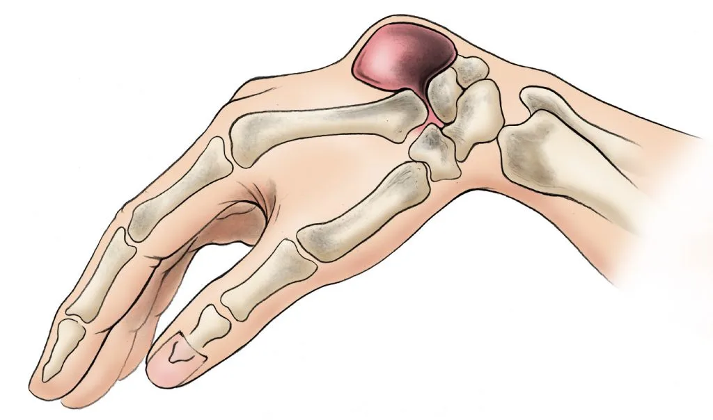 a00006f01 ganglion old aaos brochure a hand kh scaled.jpg
