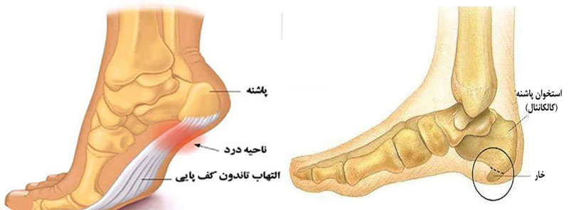 خار پاشنه
