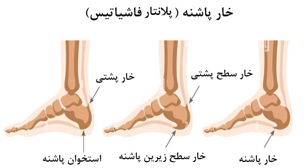 خار پاشنه