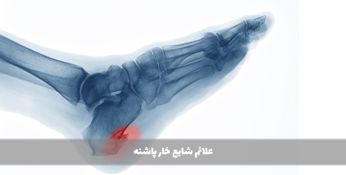 خار پاشنه