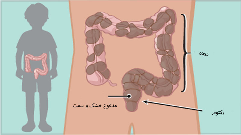 یبوست شدید