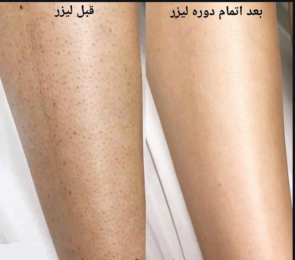 لیزر مو زائد