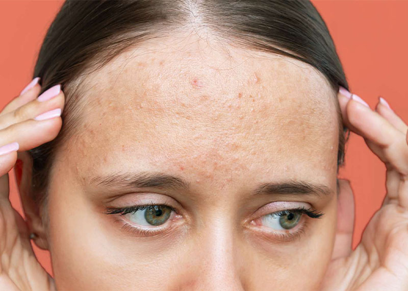 جوش زیر پوست