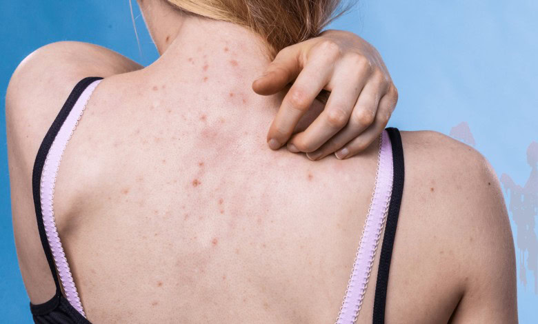 جوش زیر پوست