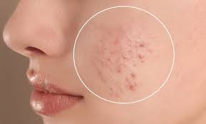 جوش زیر پوست