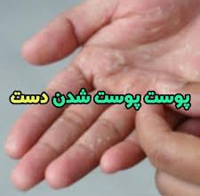 پوسته شدن کف دست