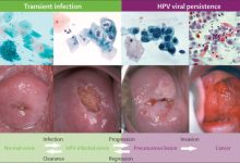 HPV