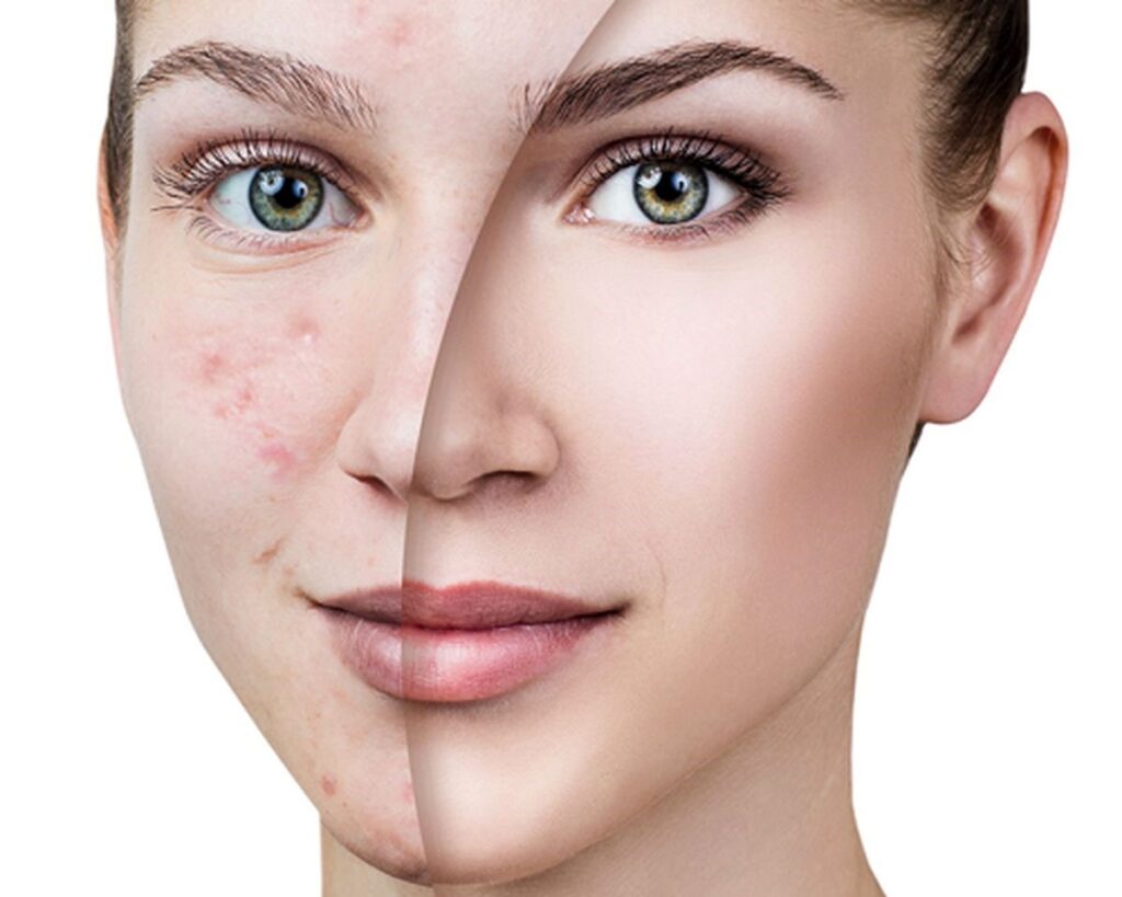 صاف شدن پوست صورت