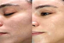 صاف شدن پوست صورت