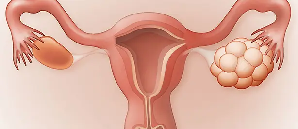 تنبلی تخمدان