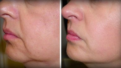 افتادگی پوست