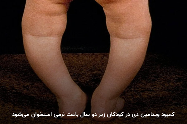 کمبود ویتامین در کودکان