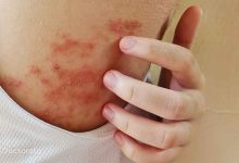 از بین بردن جوش کمر