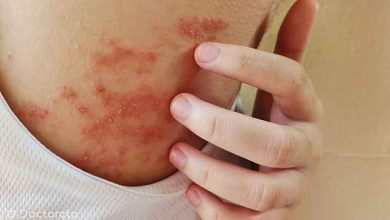 از بین بردن جوش کمر